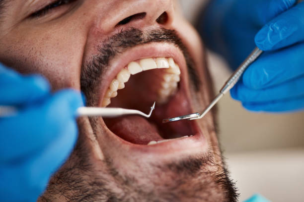 Best Emergency Dentist for Lost Fillings or Crowns in Sharon, TN